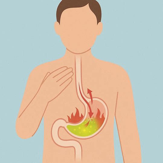 7 Penyebab dan Gejala Asam Lambung Naik (GERD) yang Perlu Diwaspadai